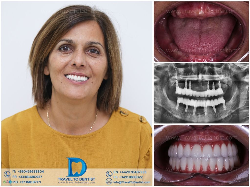 Caso dental 5 - ortodoncia completada con resultados excepcionales