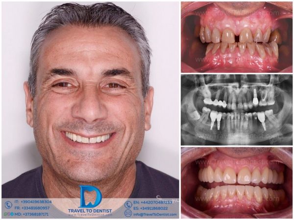 Caso dental 2 - tratamiento de ortodoncia antes y después