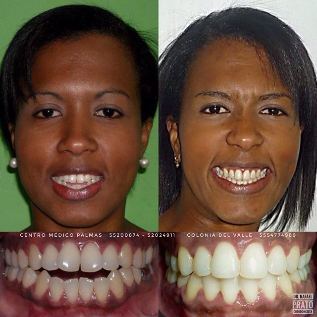 Caso dental 4 - transformación con ortodoncia